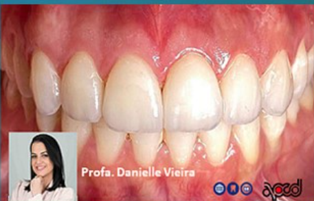 A Lente Perfeita — Imersão em Lente de Contato Dental